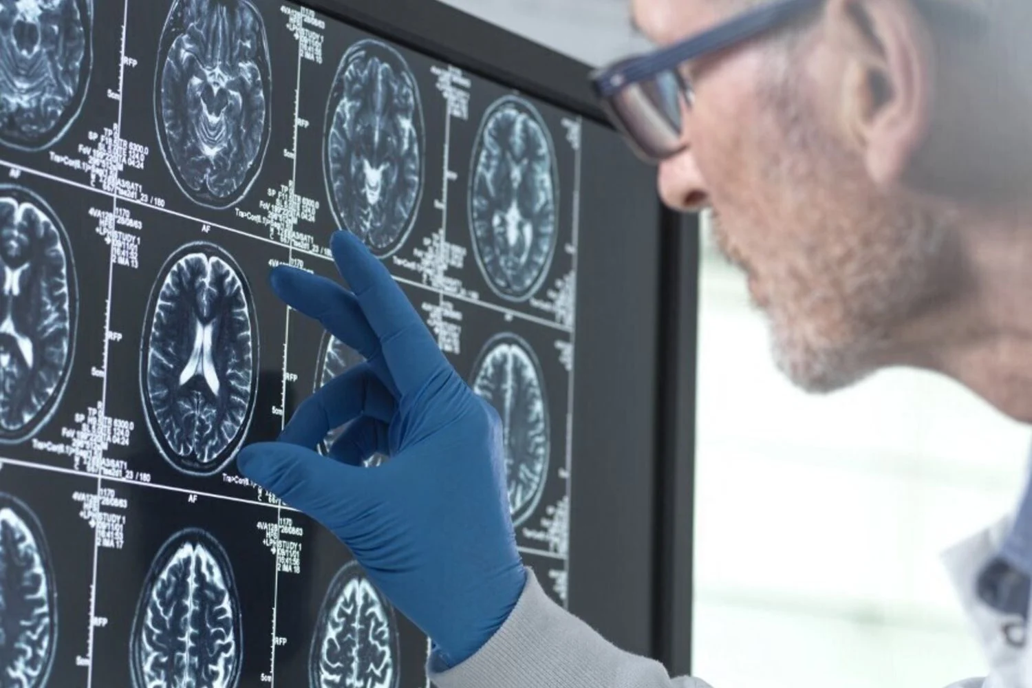 Acúmulo de proteínas nos vasos cerebrais eleva risco de demência em até 4x, indica amplo estudo