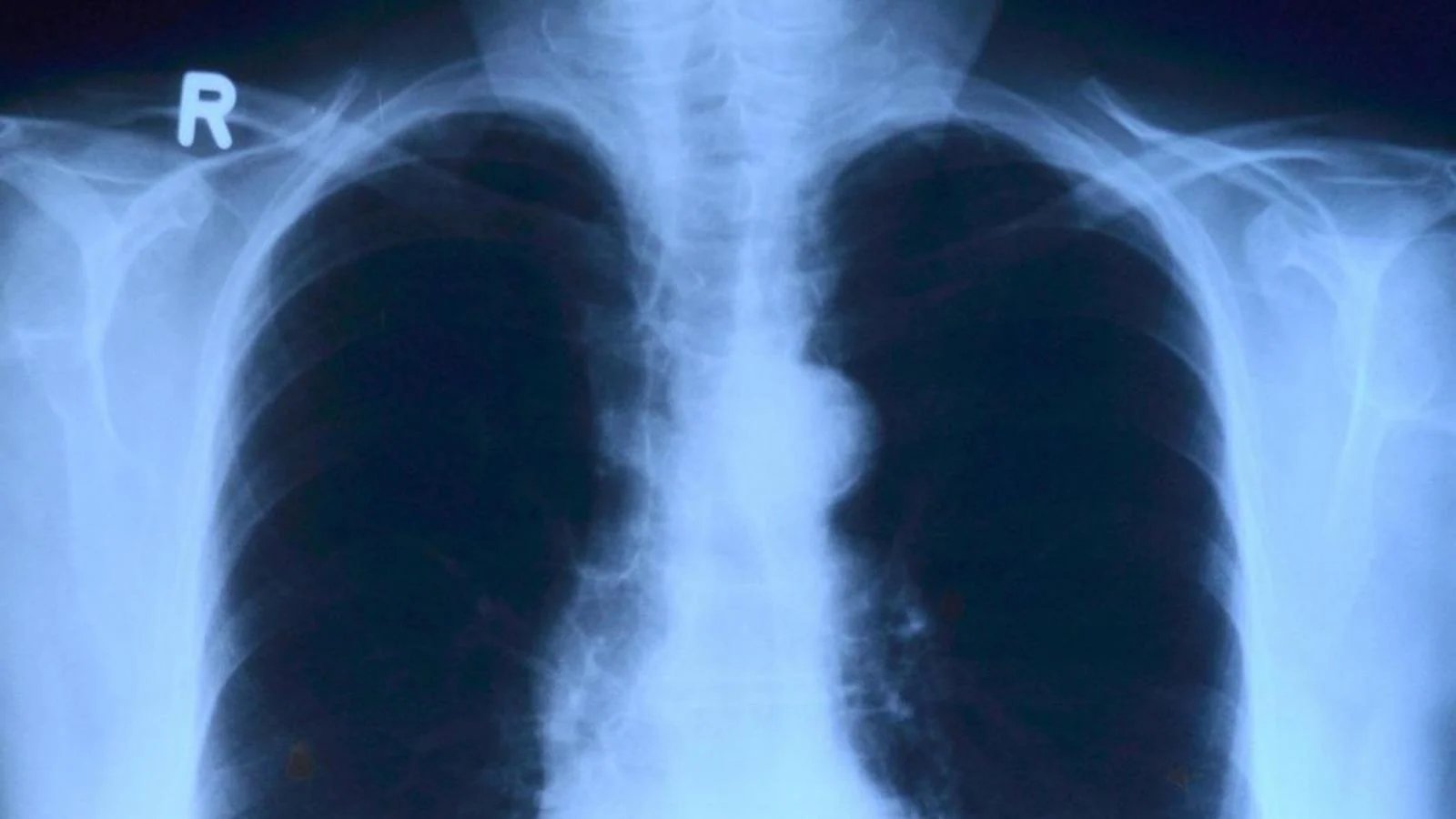 Aumento de tumores em jovens: câncer de cólon, pâncreas e pulmão em crescimento e o que podemos fazer