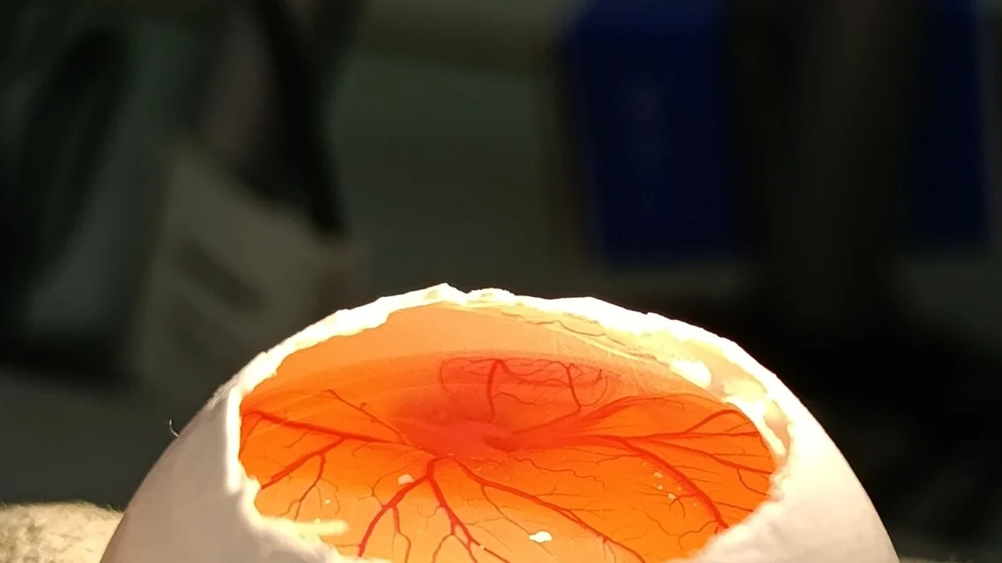 Avatar 3D do tumor: Nova janela para entender o osteossarcoma pediátrico