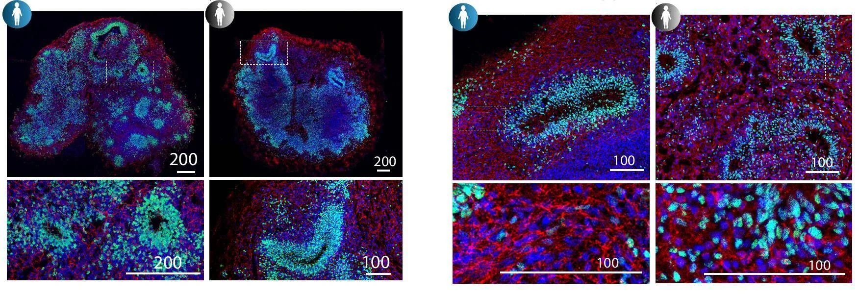 Estudo italiano revela que a SMA atinge o embrião: triagem neonatal e tratamentos precoces são decisivos