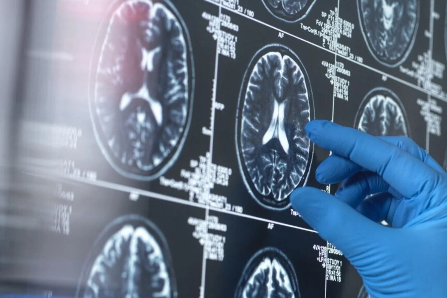 Exposição ao chumbo aumenta risco de Alzheimer e demência, mostra estudo da Universidade do Michigan