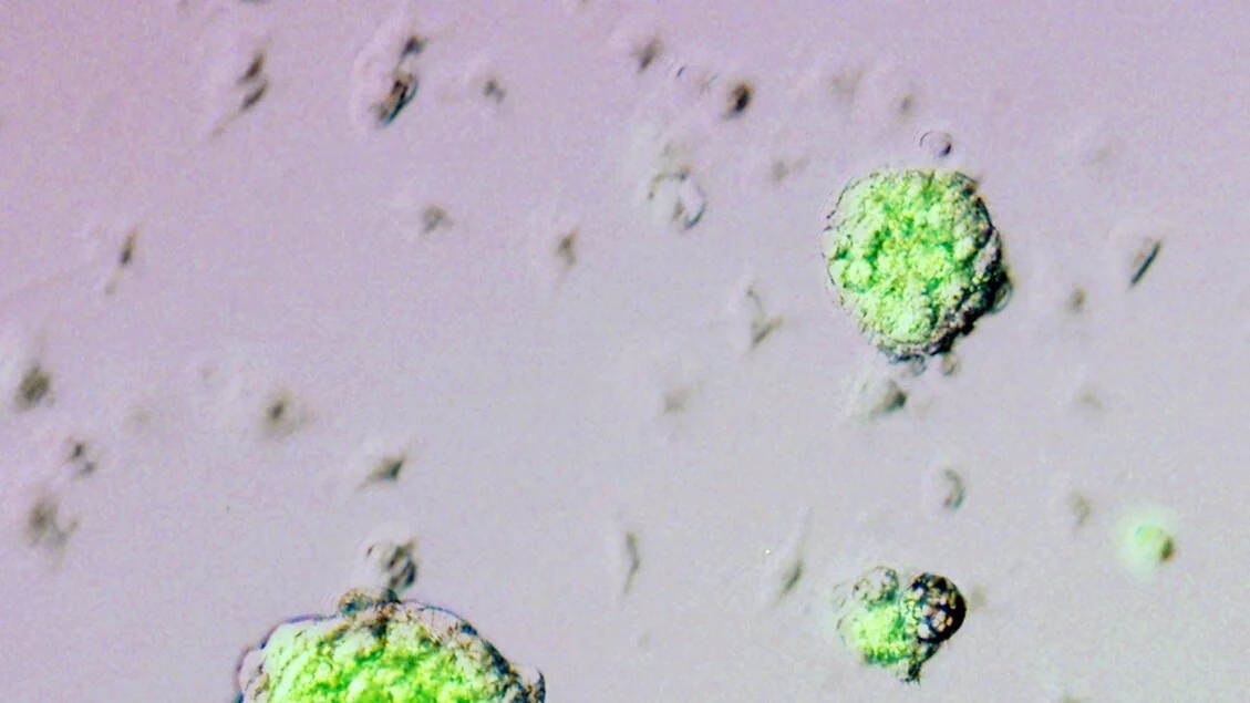 Crovalimab: nova infusão subcutânea mensal oferece esperança para quem tem hemoglobinúria paroxística noturna