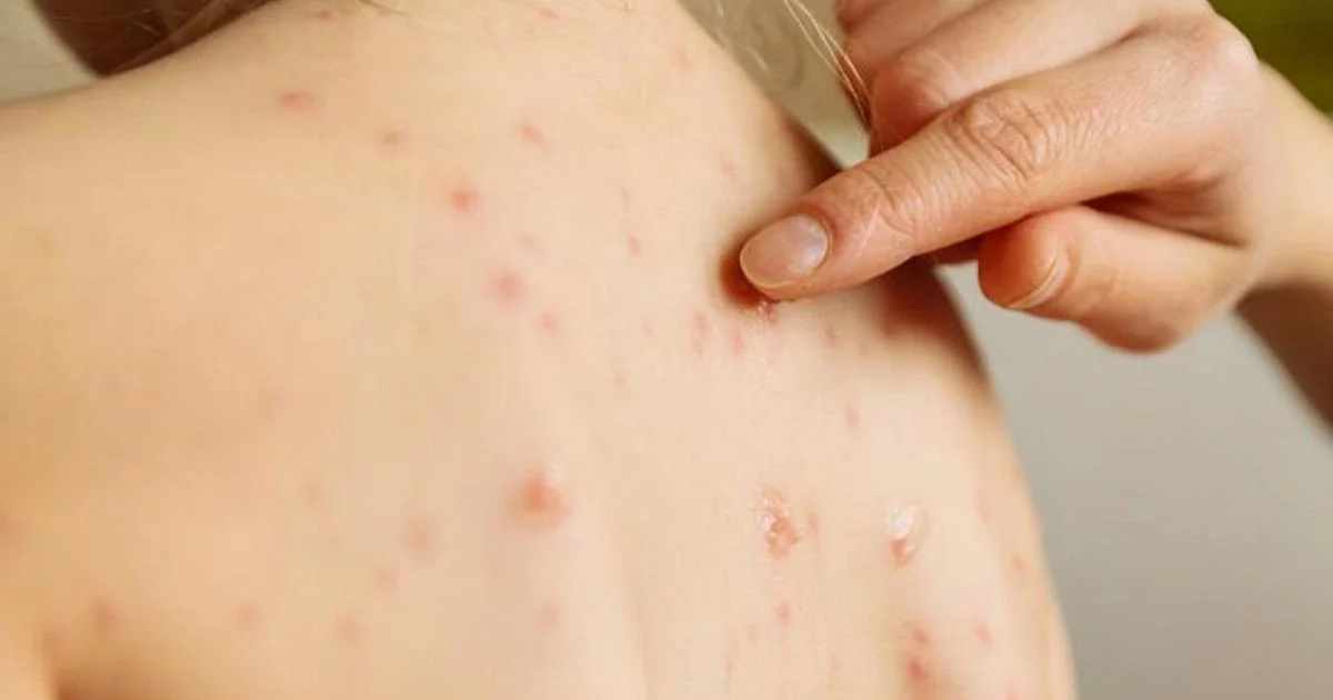 Aumento de casos de sarampo na Itália: janeiro de 2026 registra 84 notificações, mais de 1 em 3 com complicações