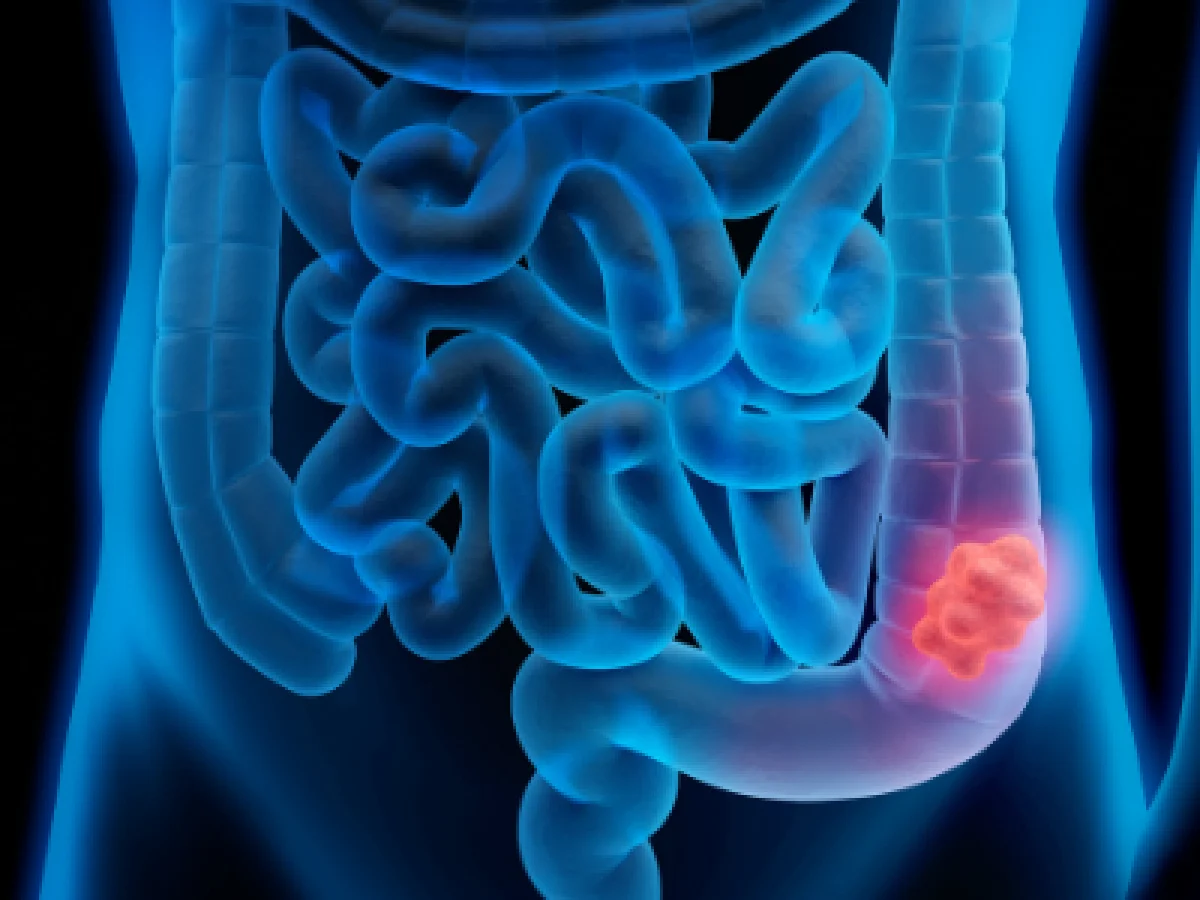 Nova combinação dupla de fármacos dobra a sobrevida em câncer colorretal metastático com mutação BRAF