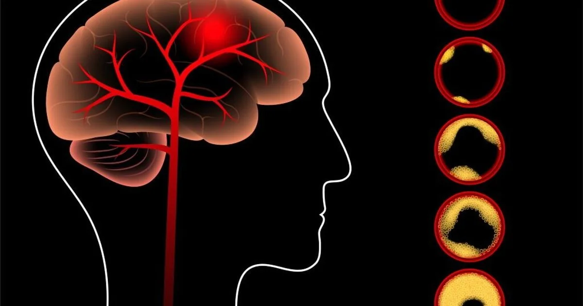 Reduzir a idade biológica protege o cérebro e reduz risco de ictus, diz estudo