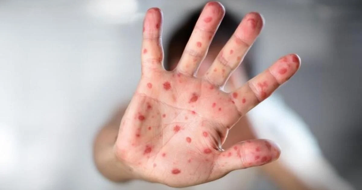 Sarampo na Itália: 485 casos até novembro de 2025 e 1 em 3 com complicações, alerta ISS