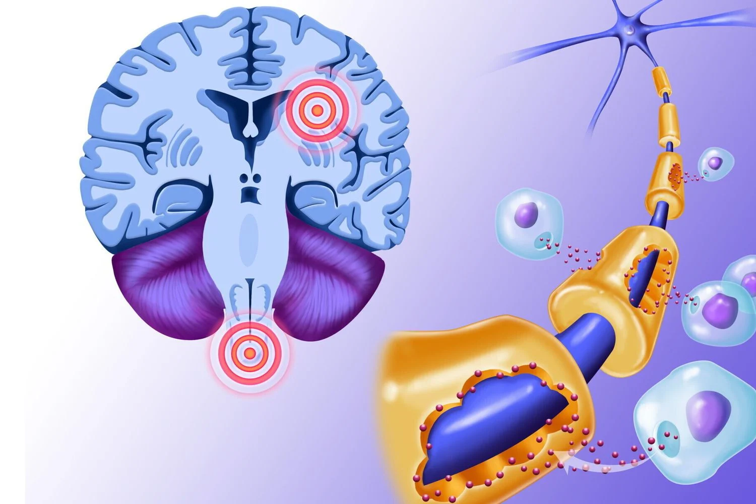 Estudo revela como vírus de Epstein-Barr e gene HLA-DR15 desencadeiam a esclerose múltipla