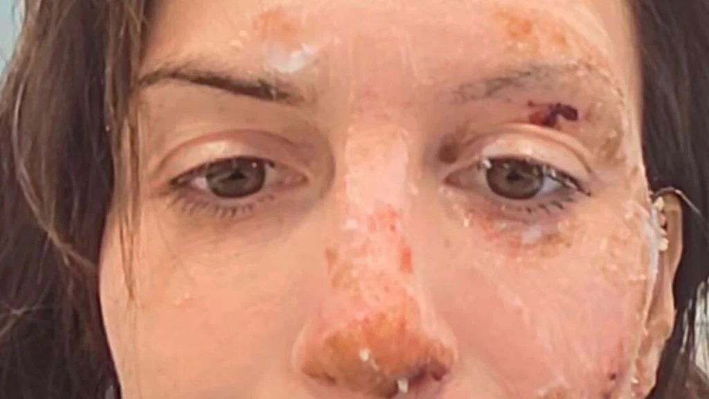 Eleonora Palmieri racconta Crans-Montana con le sue cicatrici — agi.it