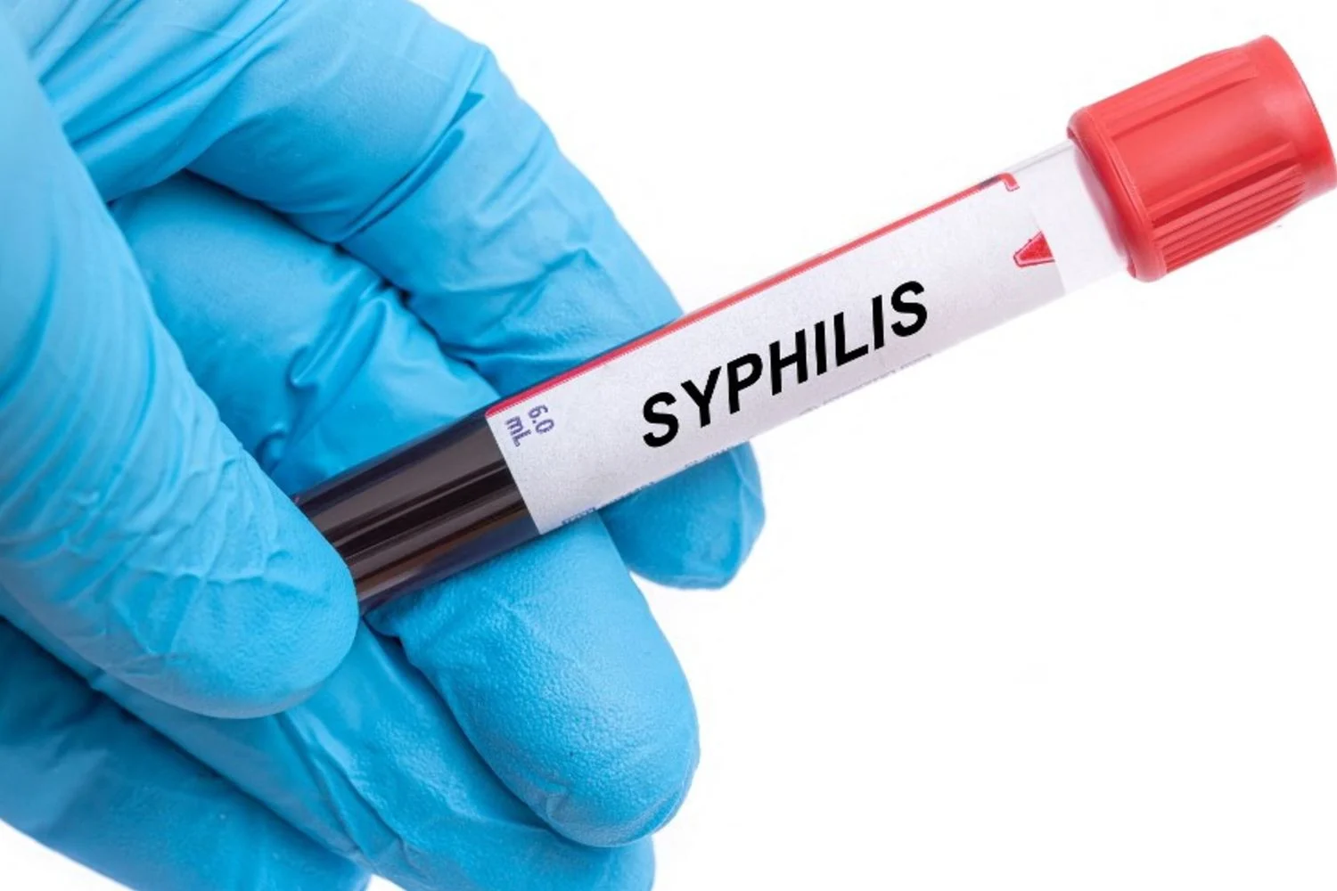 Genoma antigo de Treponema pallidum indica presença de sífilis nas Américas 3.000 anos antes dos europeus