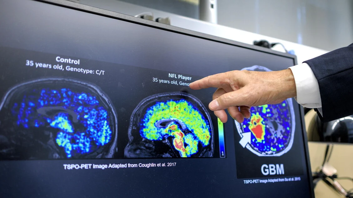 Itália tem 1,43 milhão com demência, maior proporção da UE; casos devem subir 54% até 2050